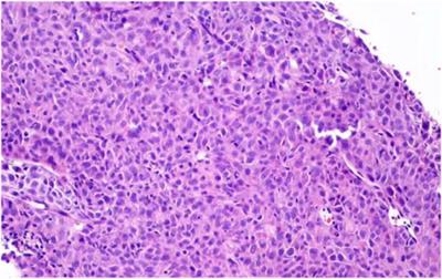 Case Report: Pulmonary sarcomatoid carcinoma complicating TP53 mutation treated successfully with Tislelizumab combined with Anlotinib—a case report